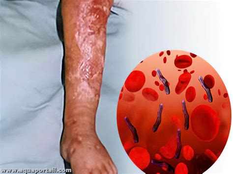septicémie staphylocoque aureus